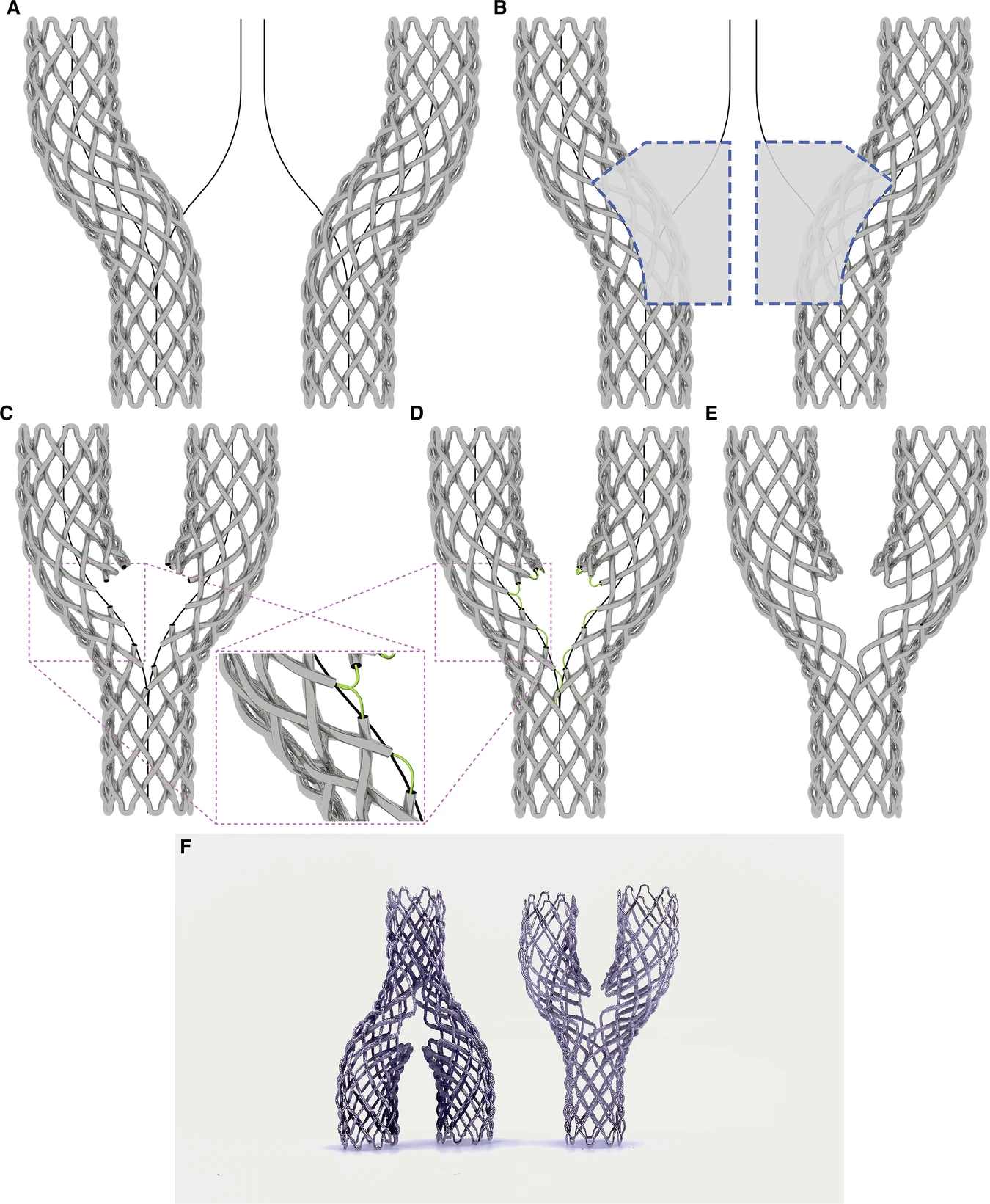 Research image related to radial compression testing of 3D-printed nitinol braided stents